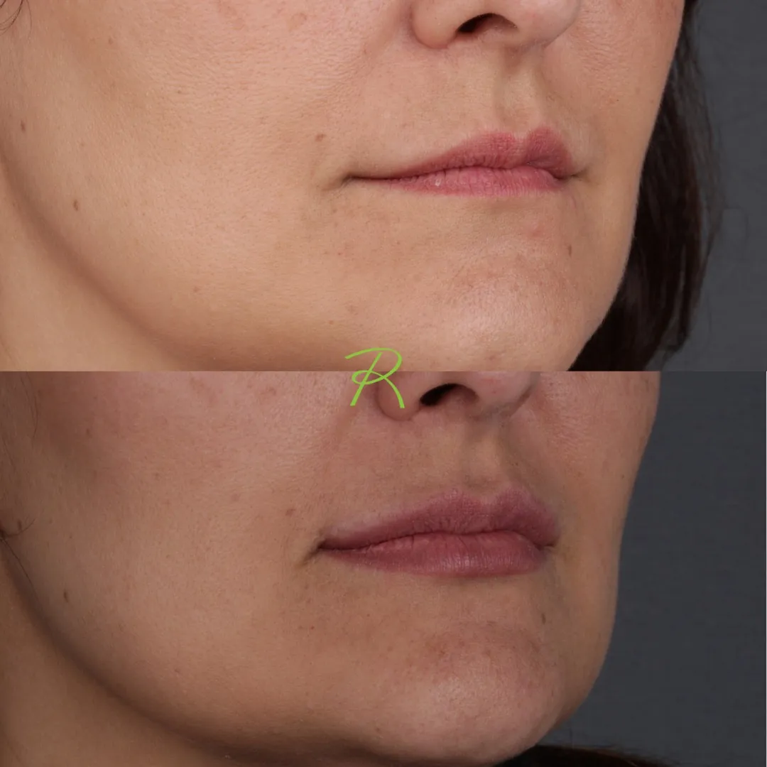 Antes e depois: Lip Lift