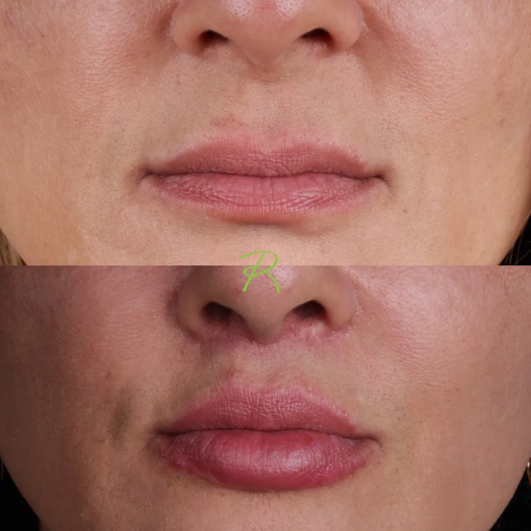 Antes e depois: Lower Lip Lift