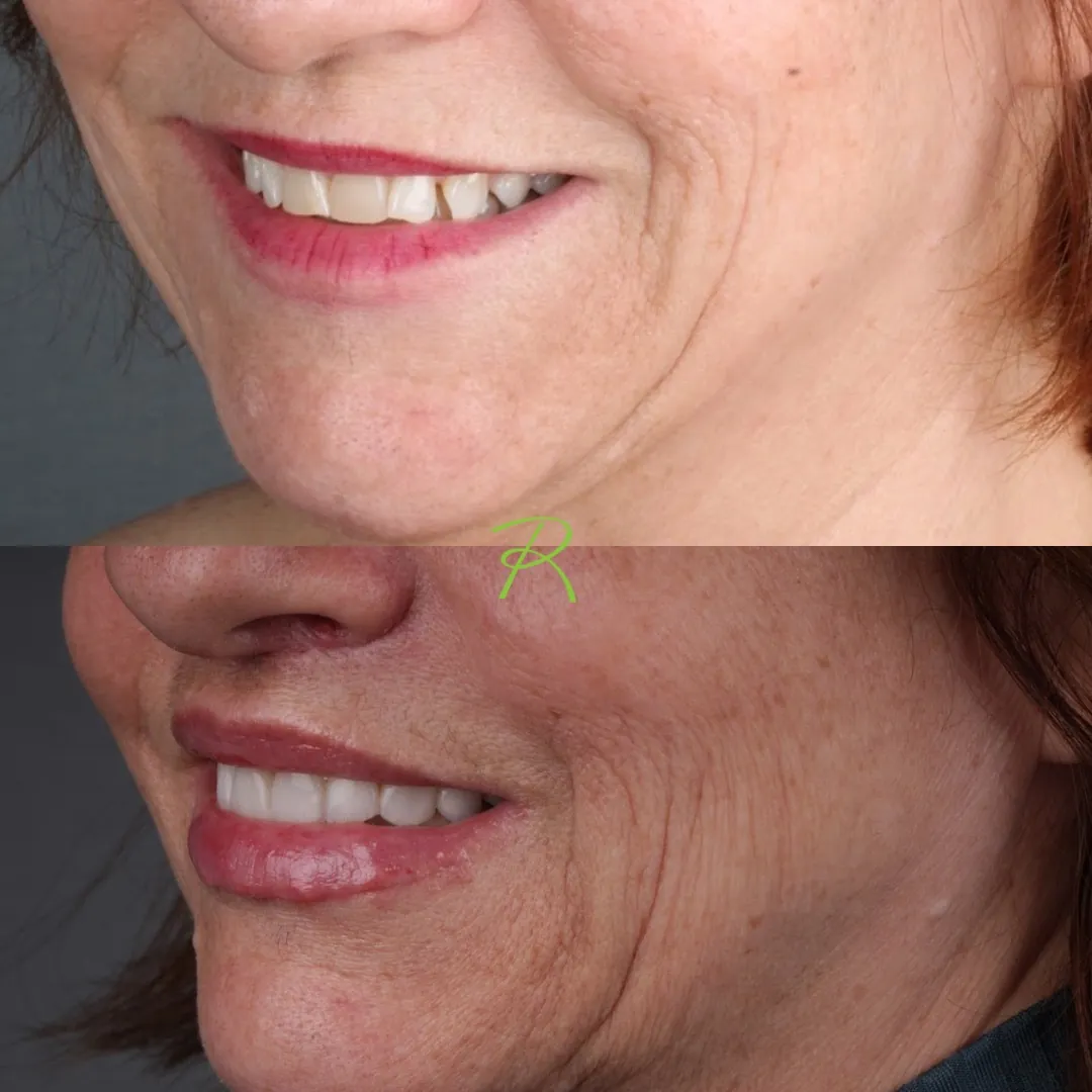 Antes e depois: Lower Lip Lift