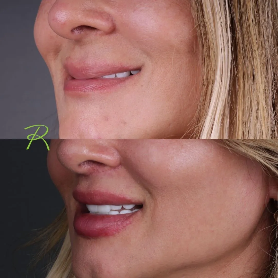 Antes e depois: Lower Lip Lift