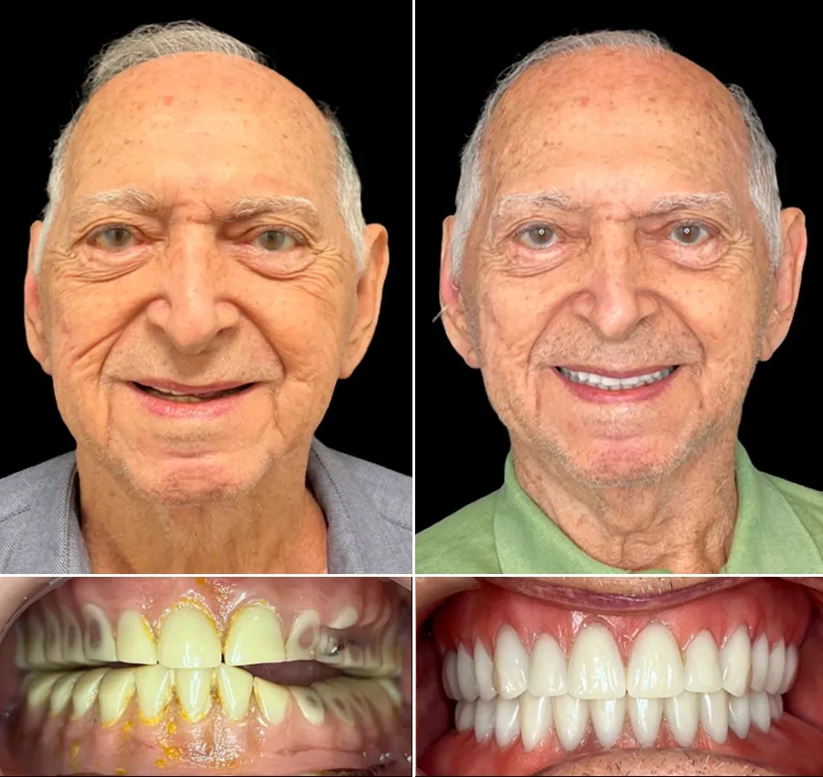 Antes e depois: Prótese total