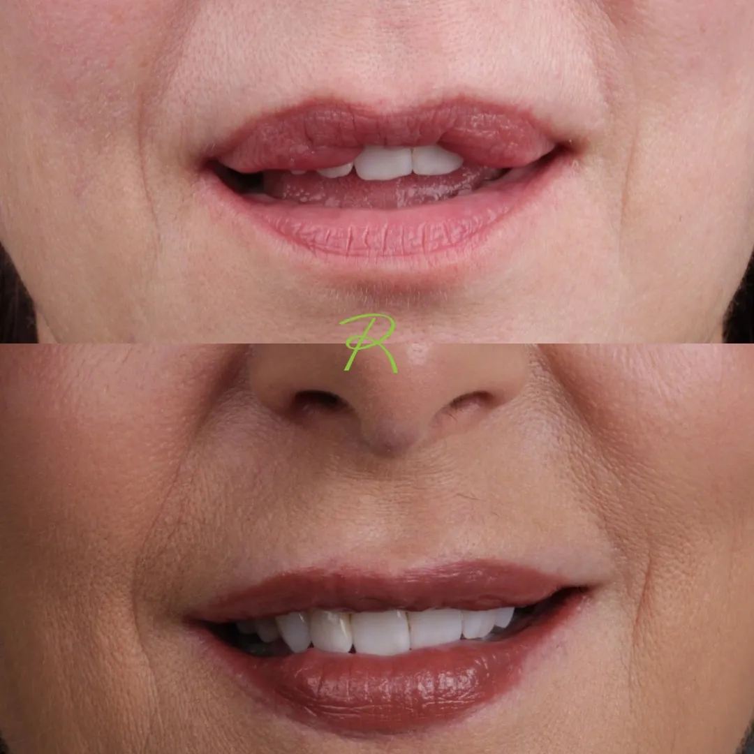 Antes e depois: Queiloplastia Redutora