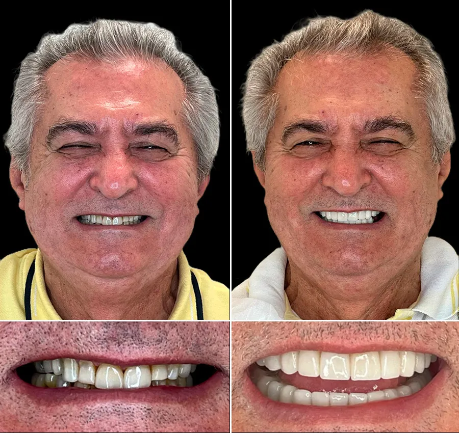 Antes e depois: Reabilitação oral