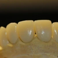 Implantes Dentários: A Escolha Premium para Reabilitação Oral e Seus Benefícios